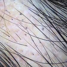 Black dots are residues of pigmented hairs broken or destroyed at scalp level. Pdf Ijdy Dermoscopic Approach To Nonscarring Alopecia