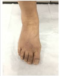 picture of the affected foot with the