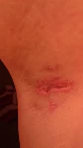 burn on armpit from laser hair removal