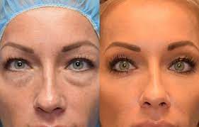 patient 38 maningas cosmetic surgery