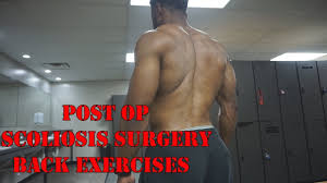 back exercises after having surgery for scoliosis
