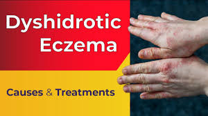 a pa s guide to dyshidrotic eczema