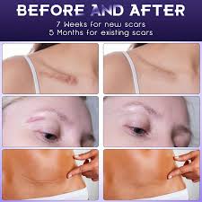 silicone scar gel for surgical scars