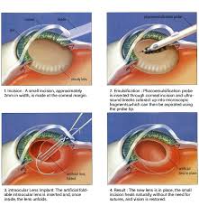best eye hospital for cataract surgery