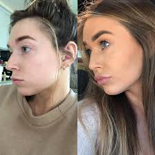 I've had the fillers for about a year now and my nose still looks perfectly fine. Before And After Make Up Wanting A Nose Bridge Filler To Fill In My Nose And Jawline Contour Plasticsurgery