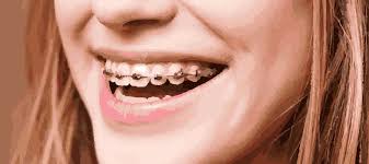 braces and 10 tv characters
