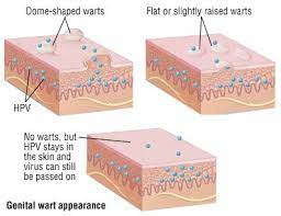 warts guide causes symptoms