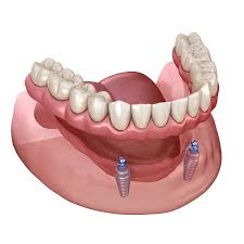 snap on dentures gordon dental