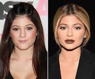 how-can-i-get-lip-fillers-without-duck-lips