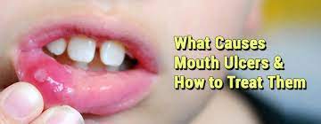 what causes mouth ulcers and how to