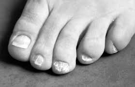 nail patella syndrome a review of the