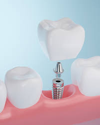 dental implants dothan al