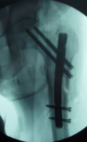 hip fracture fixation femur proximal