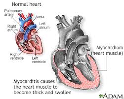 myocarditis information mount sinai