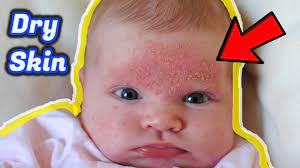 7 causes of dry skin on baby symptoms