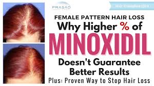 minoxidil rogaine proper use