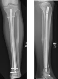 broken tibia tibial shaft fracture