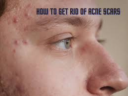 easy ways for men to get rid of acne scars