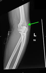 The radial collateral ligament of the elbow joint attaches to it, and also a tendon common to the origin of the lateral epicondyle fractures are rare. Lateral Epicondyle Fracture Jetem