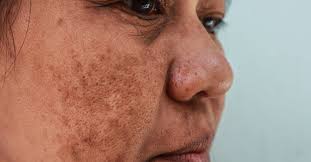 melasma in pregnancy treatment and causes
