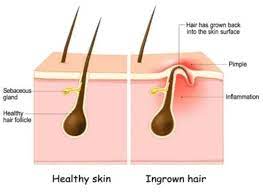 ingrown hair laser specialist nyc