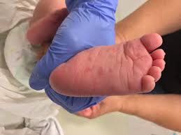 Itchy feet and hands can also be a result of a bite by the dreaded itch mite the main cause of scabies. Itchy Rash On Hands And Feet Clinical Advisor