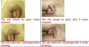 treatment of male wart