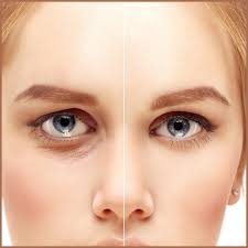 eyelid surgery in mumbai