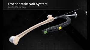 trochanteric nail system you