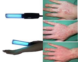 311nm Narrow Band Uvb Lamp For Treatment Of Vitiligo Psoriasis And Skin Disorder Home Use Buy Ultraviolet Lamps Physical Therapy Equipments Laser Beauty Equipment Product On Alibaba Com