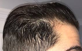 I recently got a haircut after the second session and noticed that my scalp. Dermarolling Success 2 Months In Pictures Attached Hairlosstalk Forums