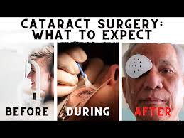 after cataract surgery