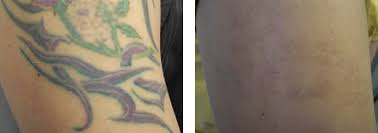 laser tattoo removal bloom laser clinic