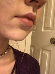botox lip flip to help with downward