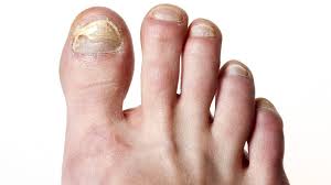various types of toenail fungus
