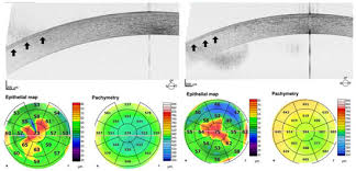 Epithelial Basement Membrane Dystrophy