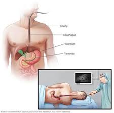 Pancreatic cancer symptoms to take seriously. Surgery For Pancreatic Cancer Overview