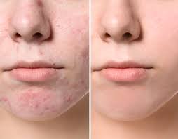 acne advanced skin and laser center