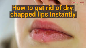 chapped lips instantly