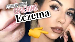 eczema foundation routine full