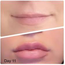 top 10 best lip injection in denver co