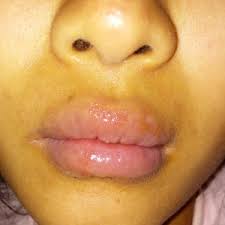 after juvederm lip fillers pus comes