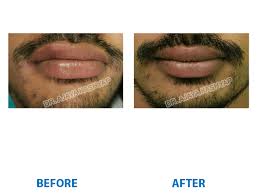 lip reduction surgery before and after