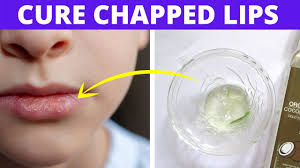 how to cure chapped lips corners fast