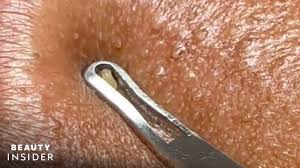 how lip blackheads are extracted