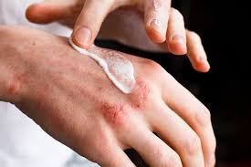 5 tips to prevent eczema flare ups