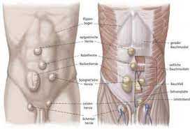 Hernias usually occur in the groin, stomach, or belly button. Bruche Hernienzentrum Benrath Sana Kliniken Ag