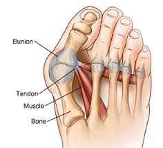 The achilles tendon connects the heel to the calf muscle and is. Osteotomy And Ligament Or Tendon Repair Bunion Surgery Saint Luke S Health System