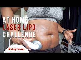 laser liposuction at home challenge