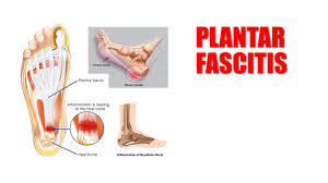 Plantar Fasciitis Self Treatment